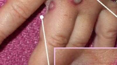 أول تعليق حكومي بشأن جدري القرود.. تعرف علي التفاصيل