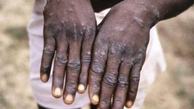 اكتشاف أكثر من 200 إصابة بجدري القرود في 23 دولة