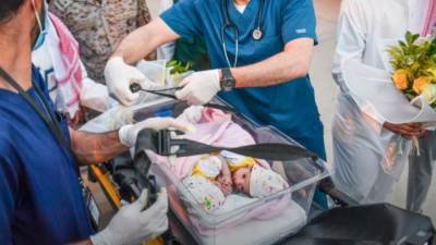 إجراء عملية فصل التوأم السيامي اليمني "مودة ورحمة" غدًا