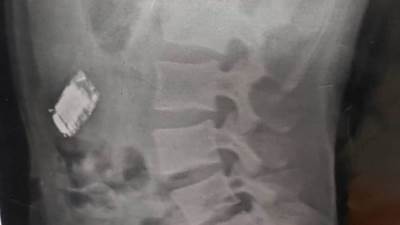 إنقاذ مسجون بالمنوفية.. أطباء يستخرجون هاتفًا محمولًا من جوف سجين في شبين الكوم