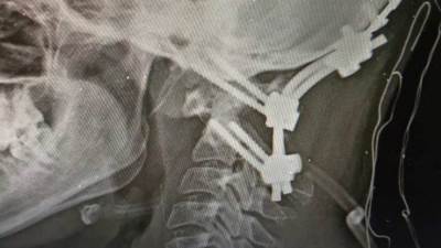 إنقاذ فتاة من شلل رباعي بمستشفى سوهاج الجامعي